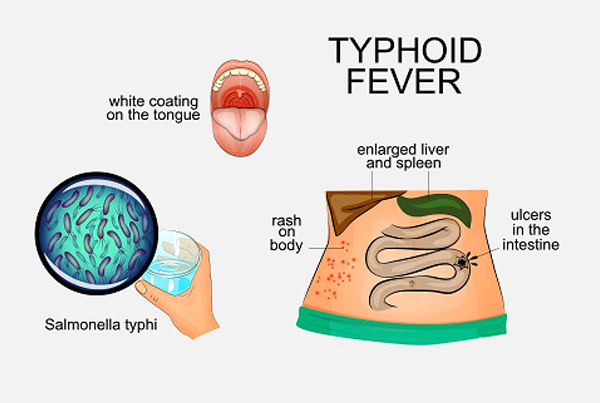 Typhoid