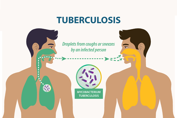 Tuberculosis