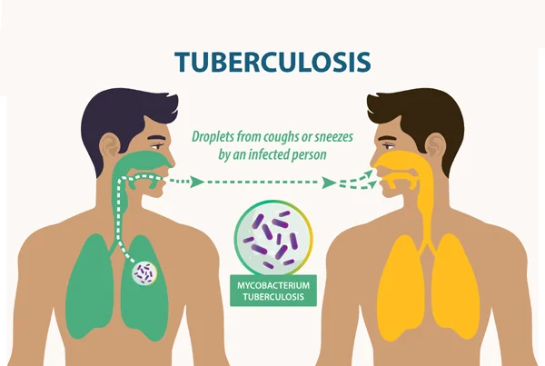 Tuberculosis