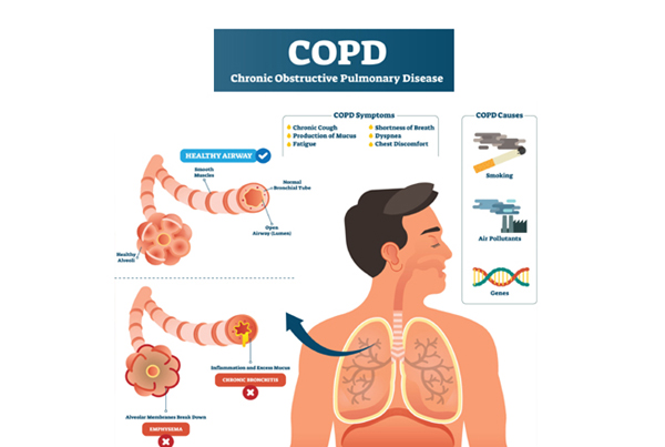 COPD