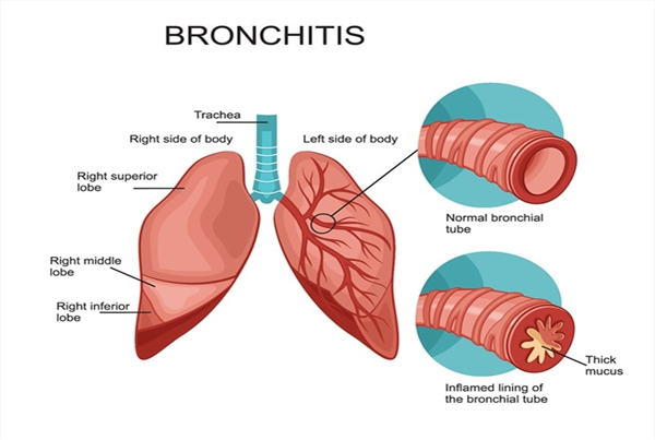 Acute and Chronic Bronchitis