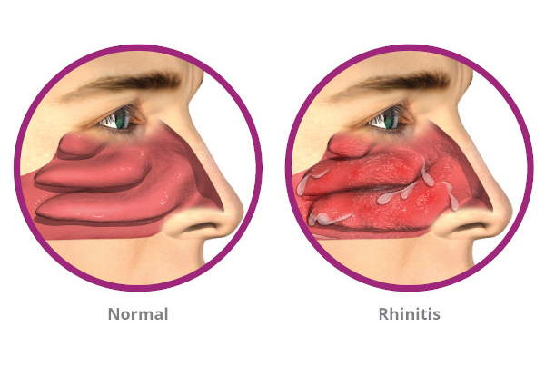 Rhinitis