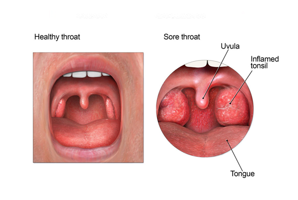 Throat Infection