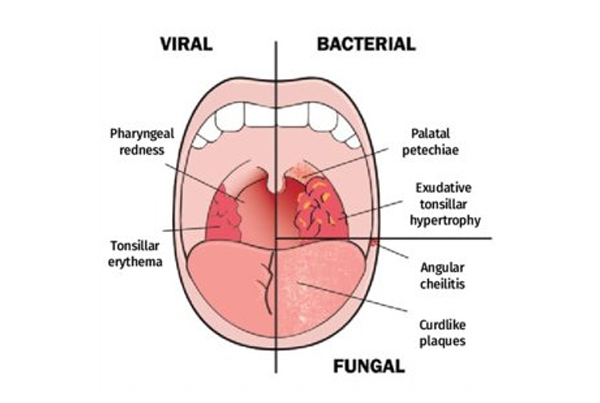 Pharyngitis