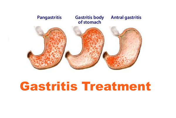 Gastritis