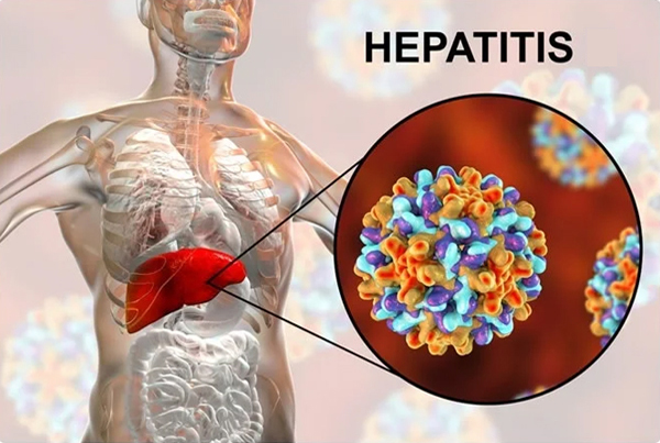 Hepatitis