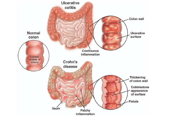 IBD