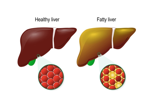 Fatty Liver