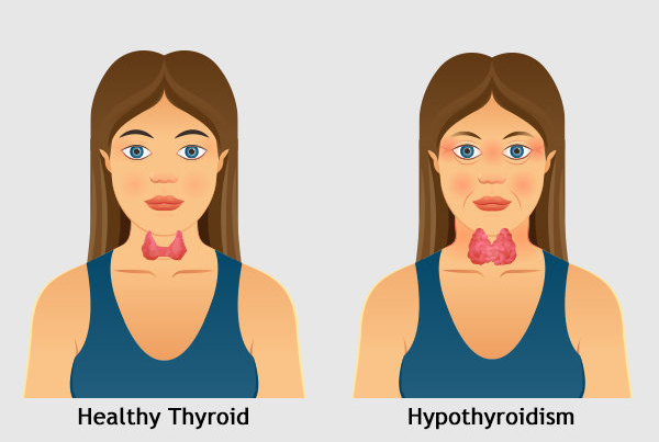 Hypothyroidism