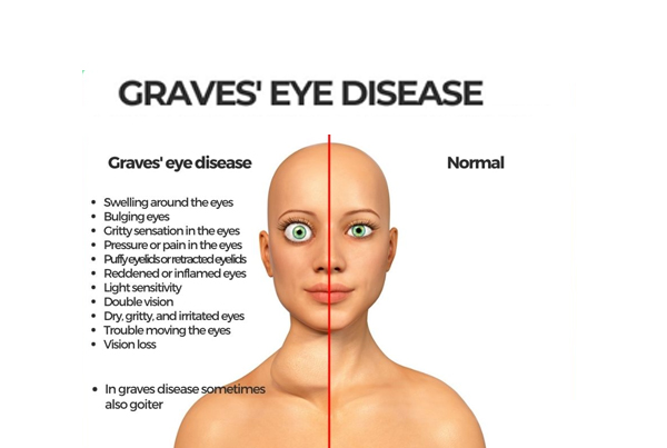 Graves Disease