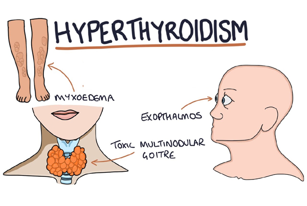 Hyperthyroidism