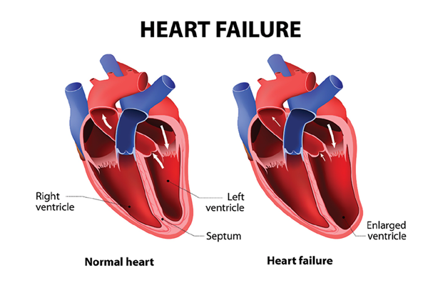 Congestive Heart Failure