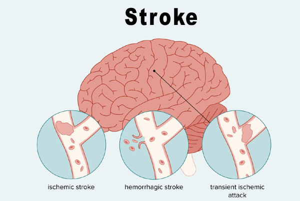 Stroke