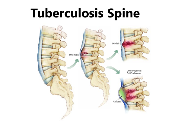 Brain and Spine Tuberculosis