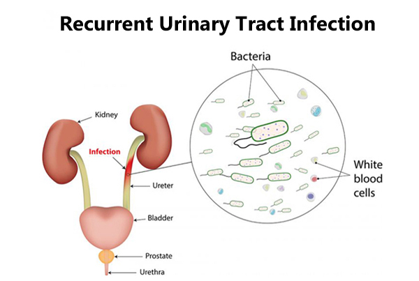 Urinary Tract Infection