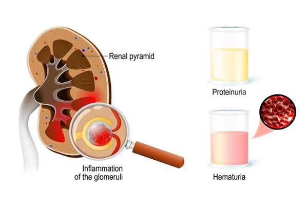 Renal Disorders