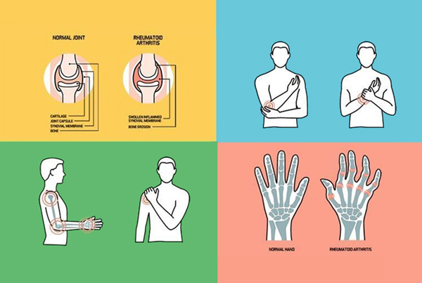 Rheumatoid Arthritis