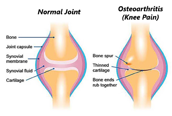 Osteoarthritis