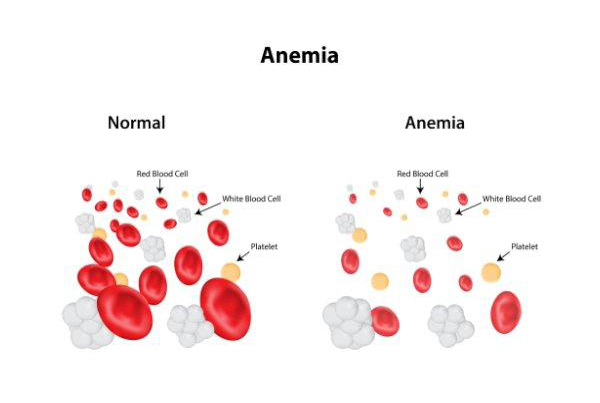 Anemia