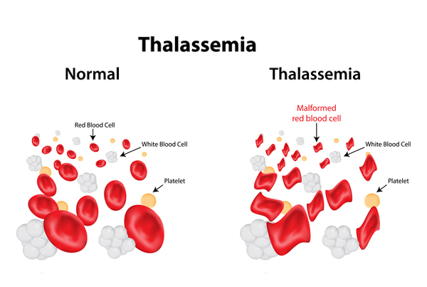 Thalassemia