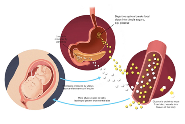 Gestational Diabetes